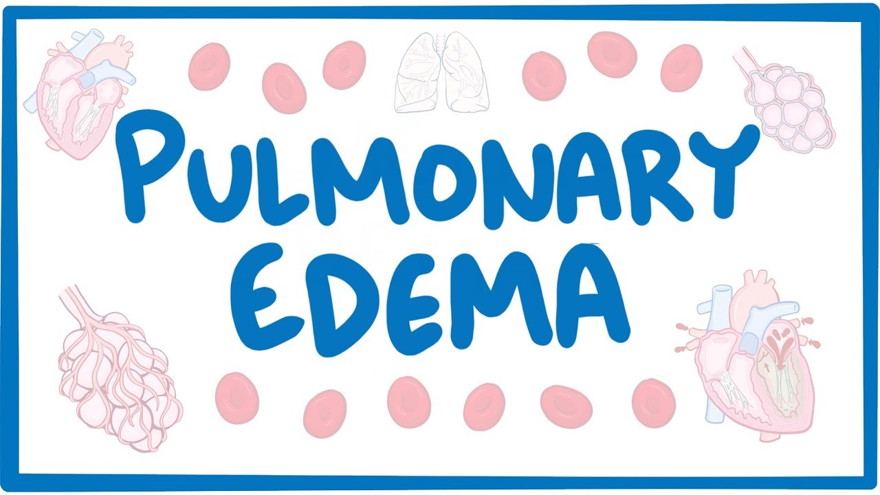 Pulmonary Edema – causes, symptoms, diagnosis, treatment, pathology